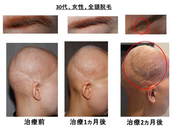 円形脱毛症　病院